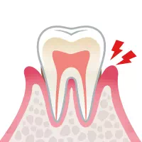 歯肉炎 イメージ