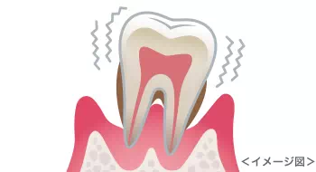 歯周炎 イメージ